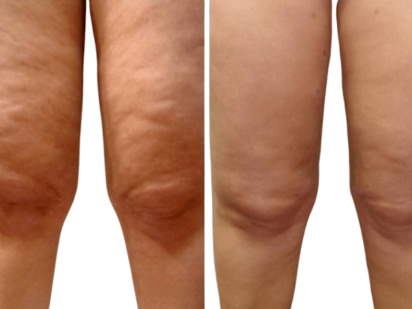 Lymphdrainage-cellulite-lipoedem-wien-cellulite-ballancer-vorher
